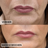 Natural Botulin LED-Infrarot-Maske